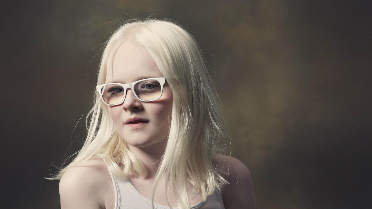 Initiativ cigar betale De sjældne - mød 7 albinoer | Samvirke