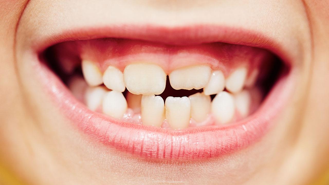 råd: Sådan passer du dit barns tænder | Samvirke