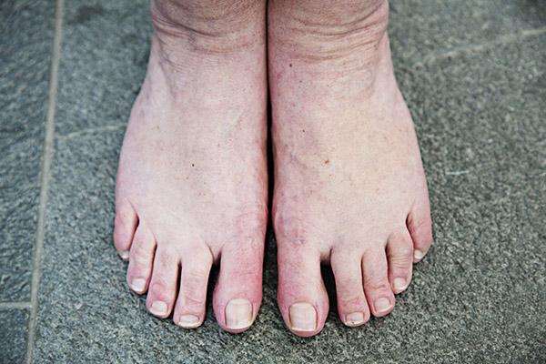 Snuble plantageejer Med det samme Danskernes fødder: Se, hvor forskellige 11 par fødder kan se ud | Samvirke